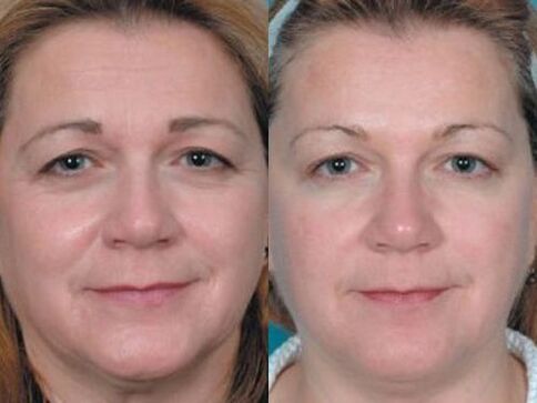 Fotos antes e despois do rexuvenecemento da pel no plasma