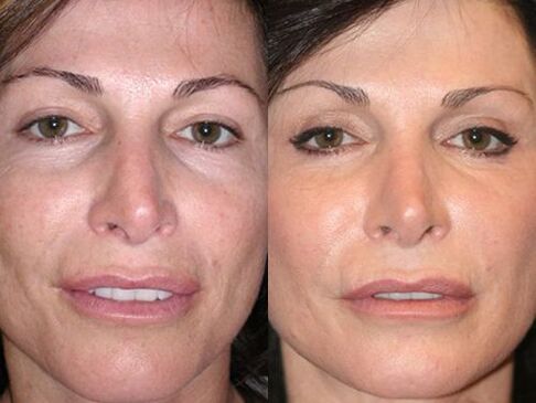 antes e despois do rexuvenecemento da pel no plasma