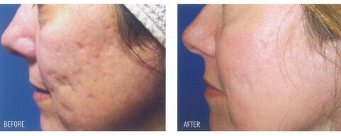 Antes e despois de usar o dispositivo láser na pel con cicatrices