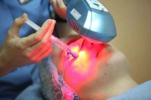 Biorevitalización láser da pel facial