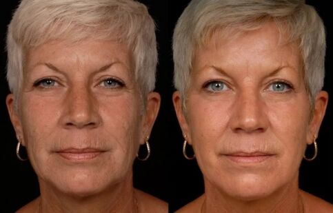 O resultado do tratamento con láser da pel facial - redución de engurras