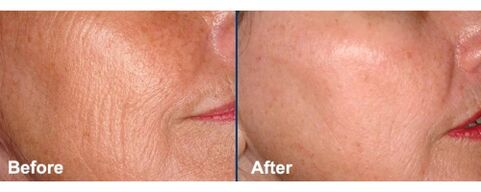 Pel facial antes e despois do rexuvenecemento con láser