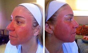 Enrojecemento facial despois do rexuvenecemento por láser