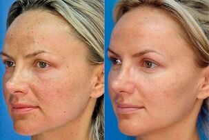 Foto antes e despois do rexuvenecemento da pel co dispositivo